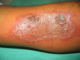 dermatitis paederus drunanfurnabsyah com